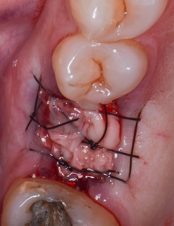 Figura 4: Alvéolo recoberto com 4 membranas de fibrina leucoplaquetária ou LPRF e sutura obedecendo a técnica open wound.