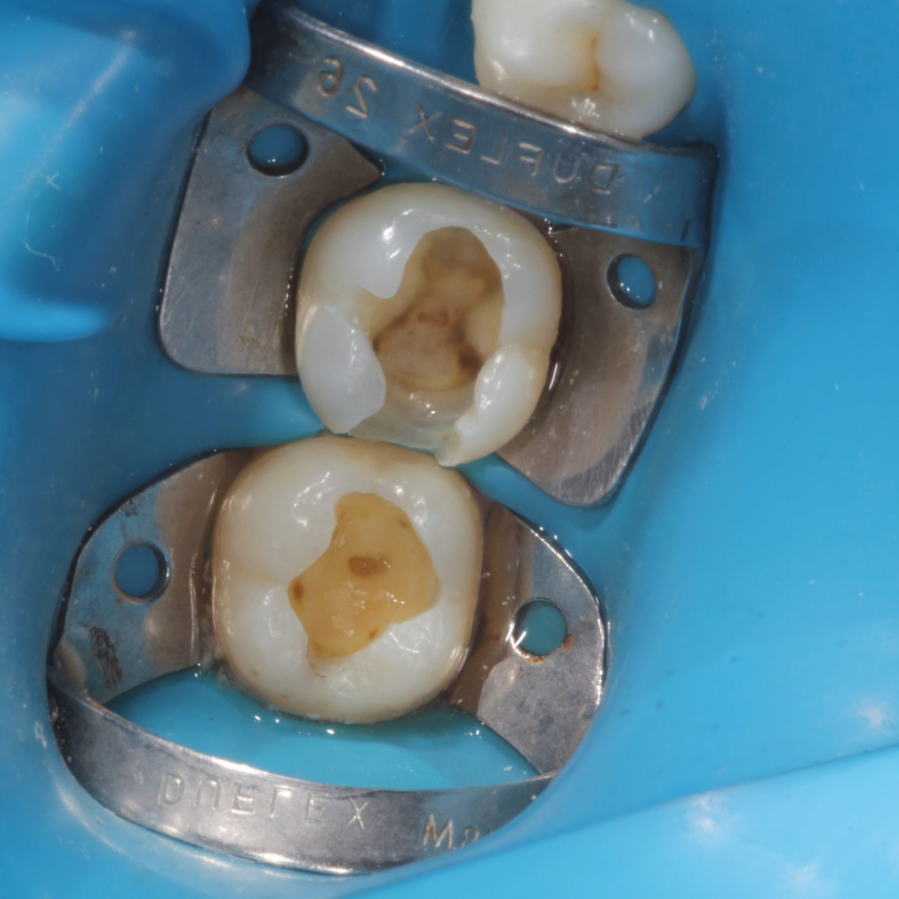 Tecido-cariado-removido-e-dente-36-com-preparo-tipo-Classe-II