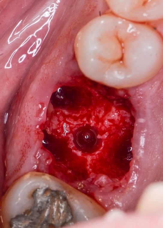 Figura 2: Septo interradicular preservado e fresado para receber o implante