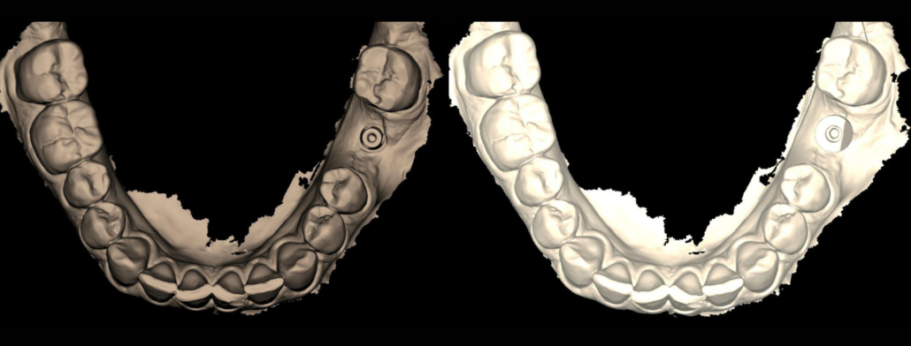 Figura 3: Pilar em posição (à esquerda) e scan body em posição no pilar (à direita).