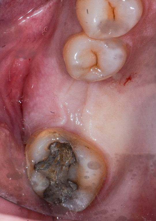 Figura 7: Aspecto da ferida com 4 meses. Notar a formação de tecido queratinizado e preservação do volume vestibular.