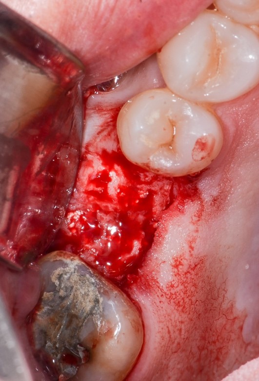 Figura 9: aspecto clínico do local durante a reabertura. Presença de formação óssea e recobrimento do tapa de silicone.