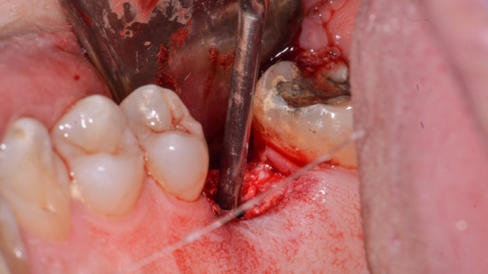 Figura 12: Aspiração da câmara do implante Arcsys utilizando uma cânula de endodontia para remover detritos e umidade.