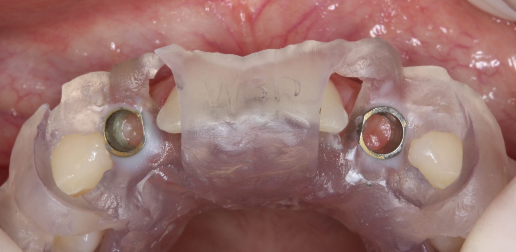 Figura 4: Adaptação do guia cirúrgico em boca.