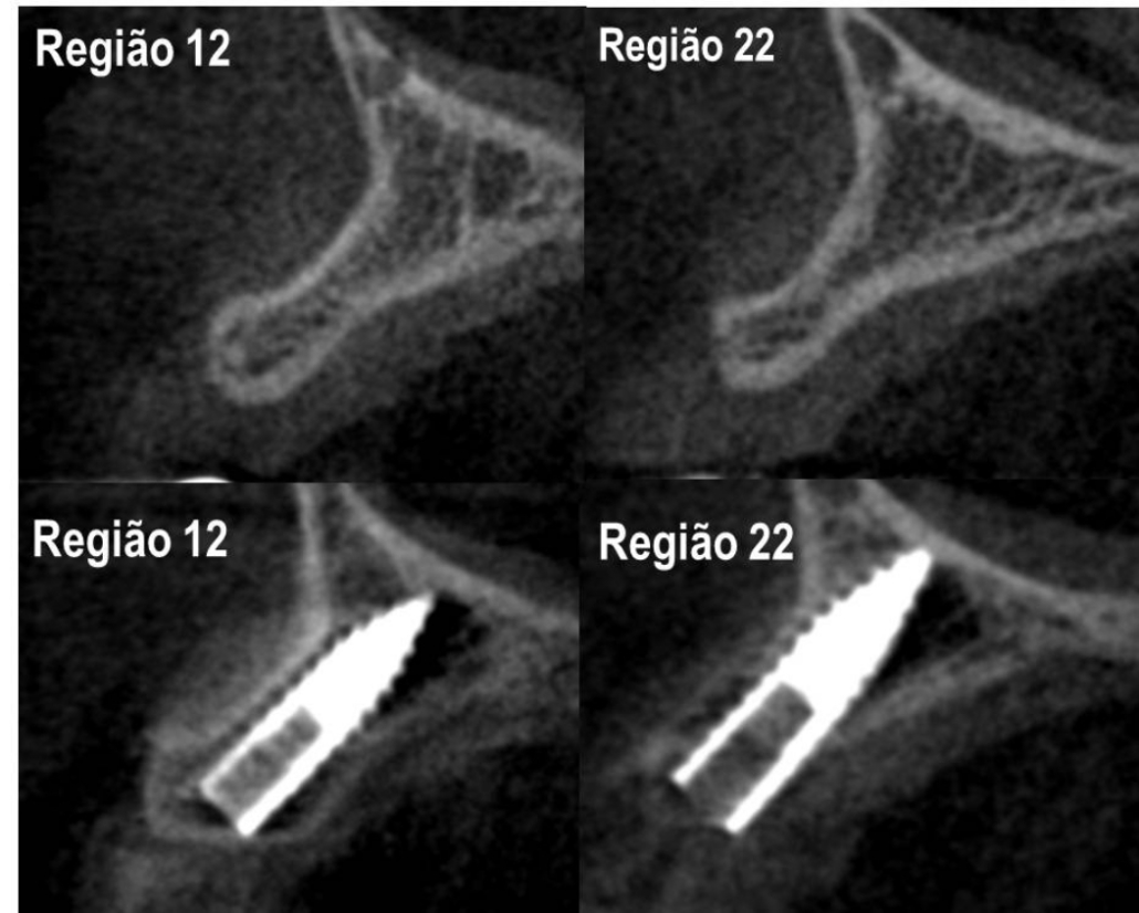 Figura 15: Imagem tomográfica pré e pós operatória comparativa.