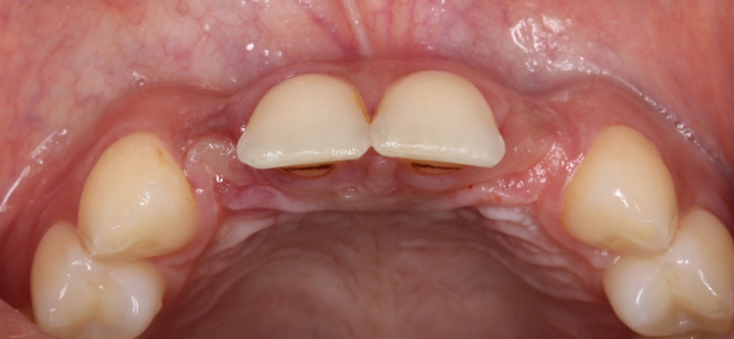 Figura 3: Fotografia inicial intra oral.