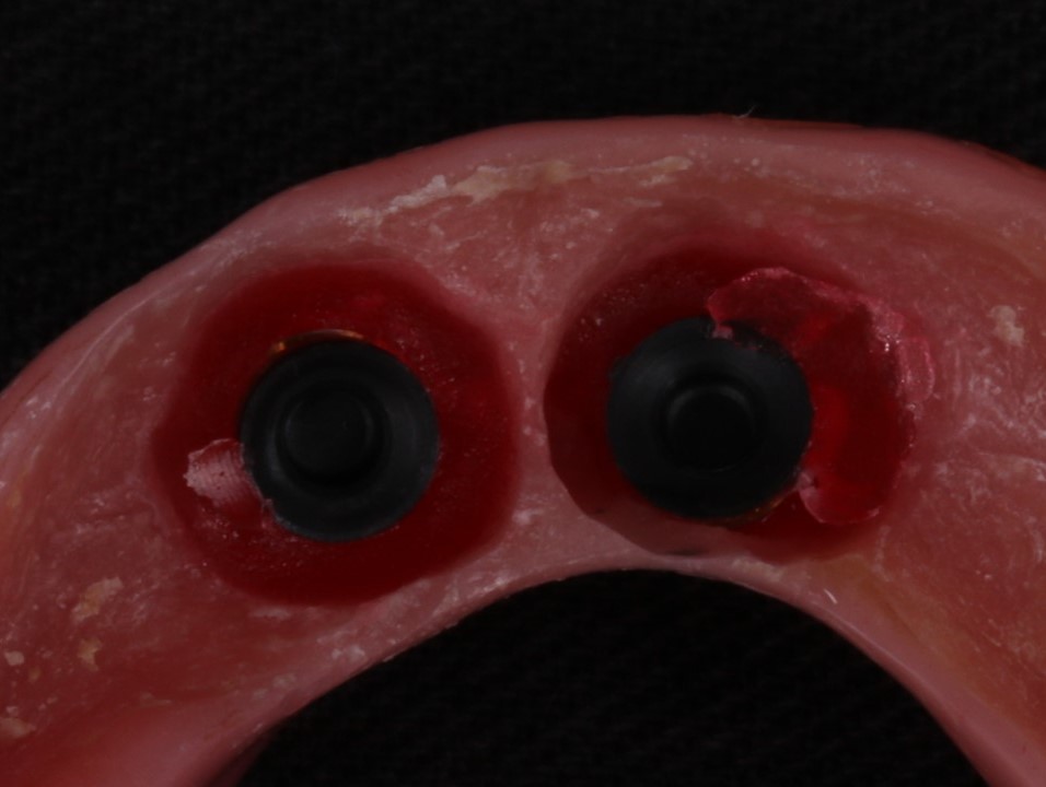 No detalhe, vista inferior da prótese após a captura das cápsulas e preenchimento dos nichos com RAAQ. Observe a presença dos retentores laboratoriais (polímero preto), utilizados para proteção das câmaras internas das cápsulas.​