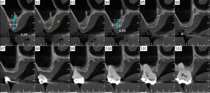 Figura 3: Cortes tomográficos 92 al 98 mostrando pérdida de altura del seno maxilar.