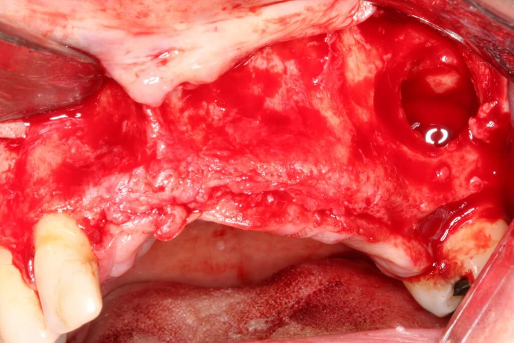 Figura 10: Despegado de la membrana del seno maxilar.