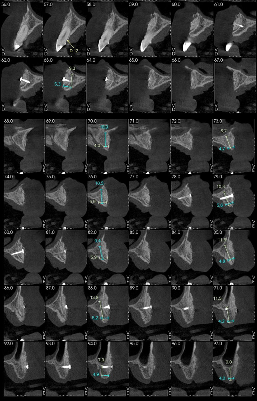 Figura 17: Cortes tomográficos del lado derecho e izquierdo con ganancia de volumen óseo.