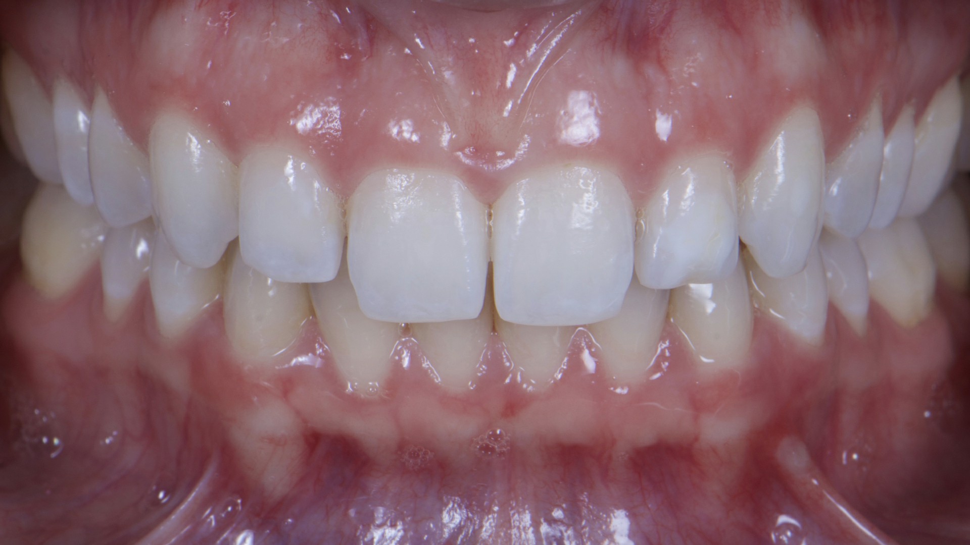 Fig.2: Foto intra oral inicial em máxima intercuspidação habitual.
