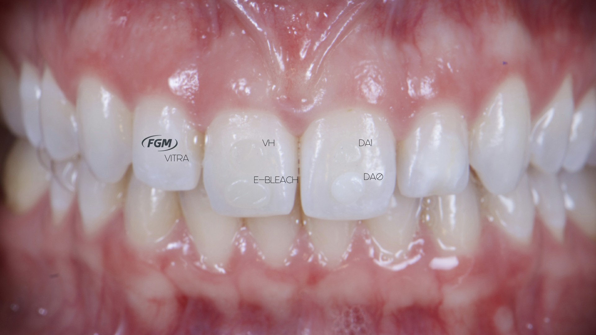 Fig.3: Selección de color a través de las esferas pre polimerizadas de los composites colocados en la estructura dental, fotocurados y humedecidos.