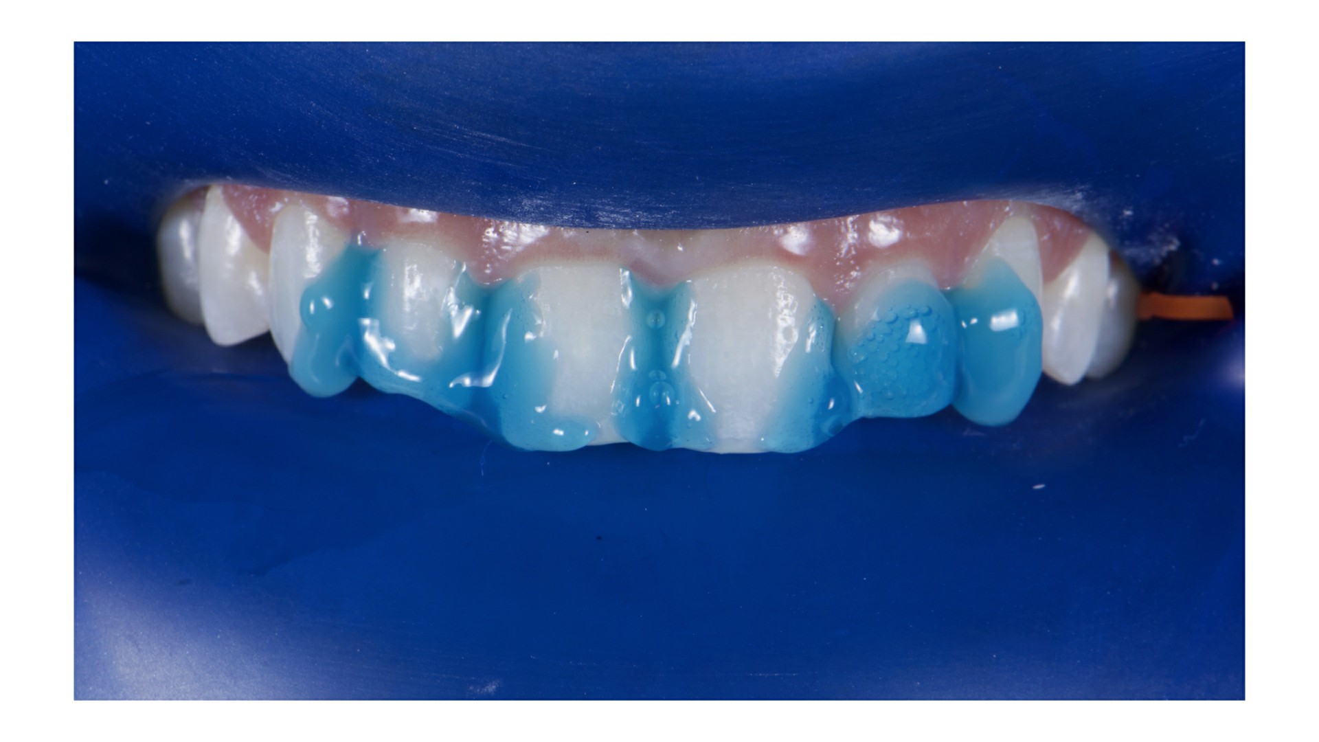 Fig.9: Condicionamento com ácido fosfórico a 37% (Condac 37) nos dentes a serem reanatomizados.