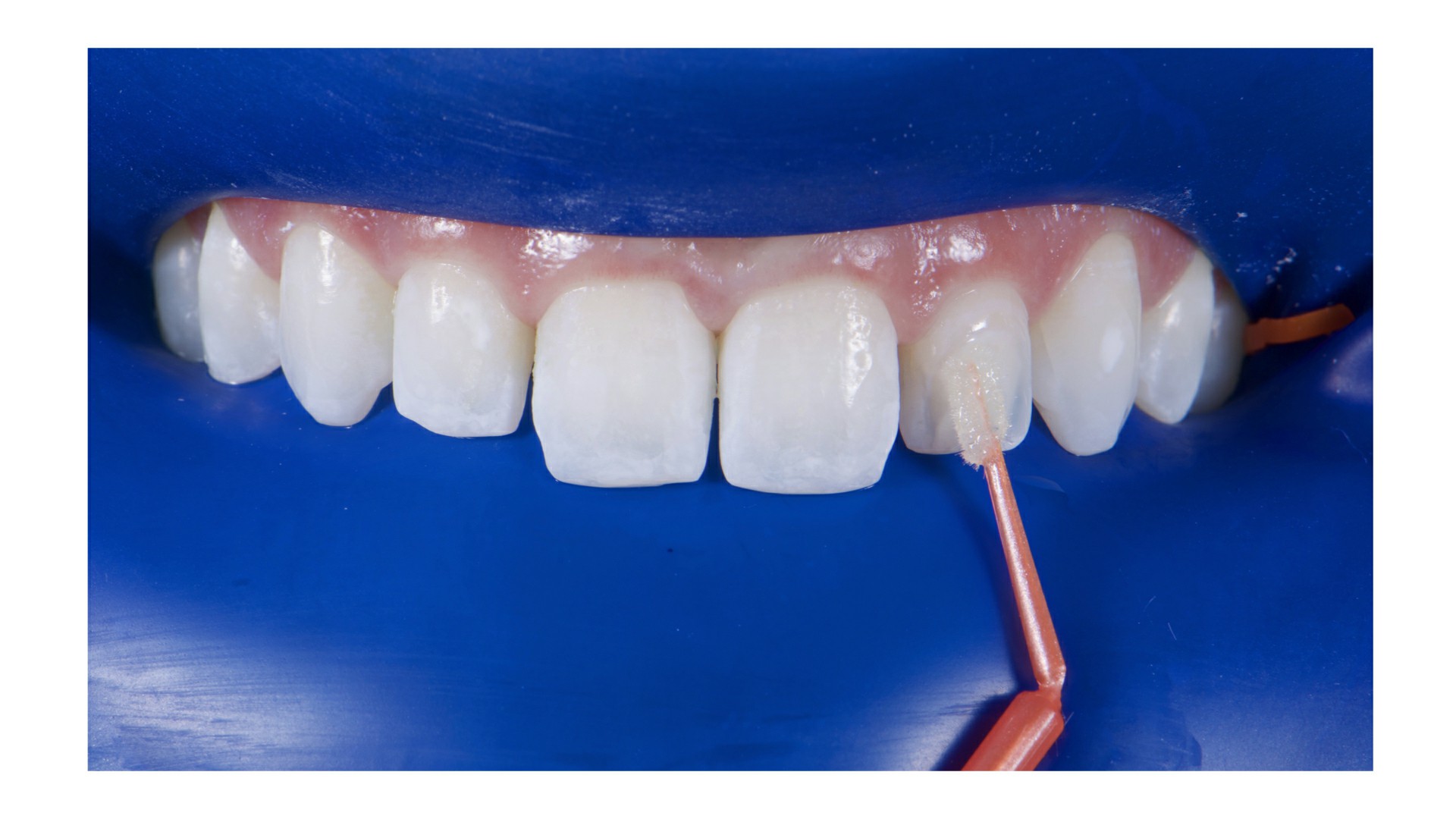 Fig.10: Aplicação do primer/adesivo (Ambar APS) nos dentes que foram condicionados.