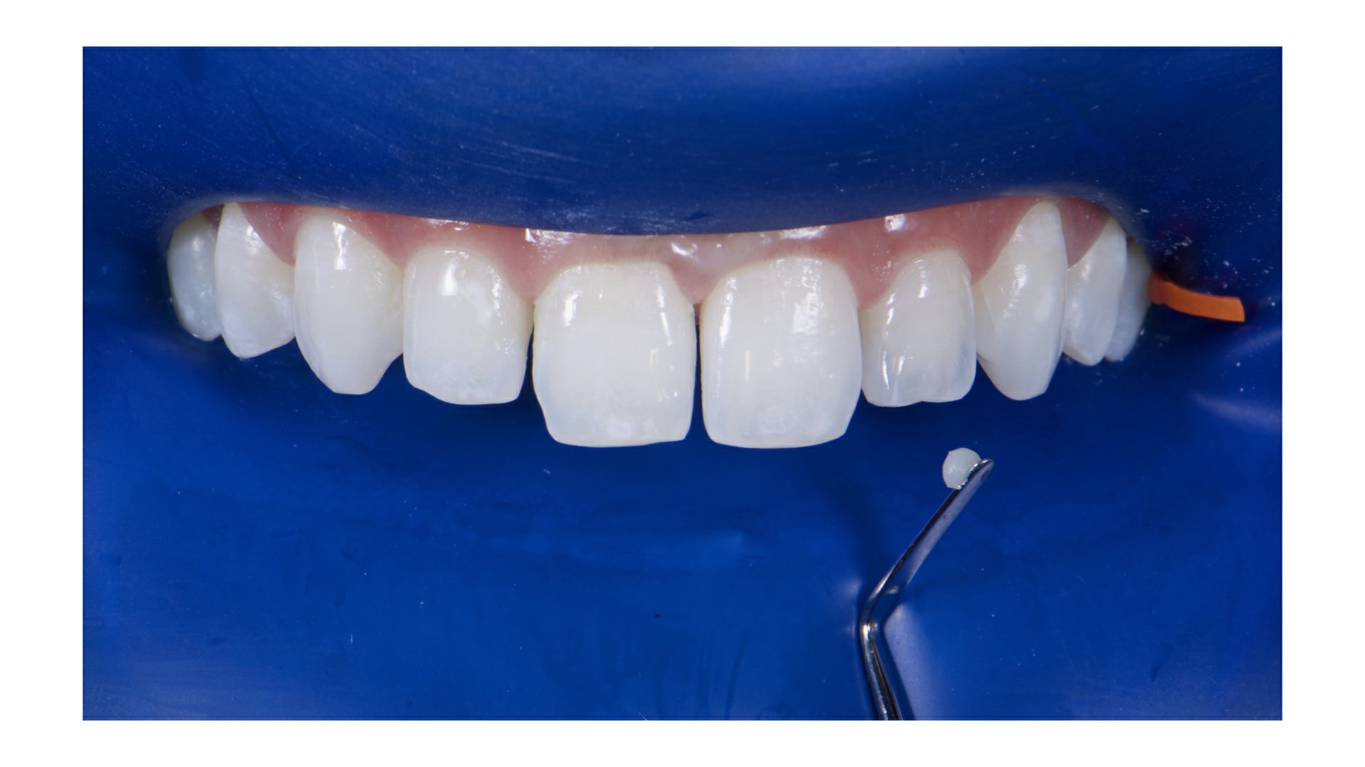 Fig.11: Inserção do incremento de dentina (DA1, Vittra APS) no dente 22.