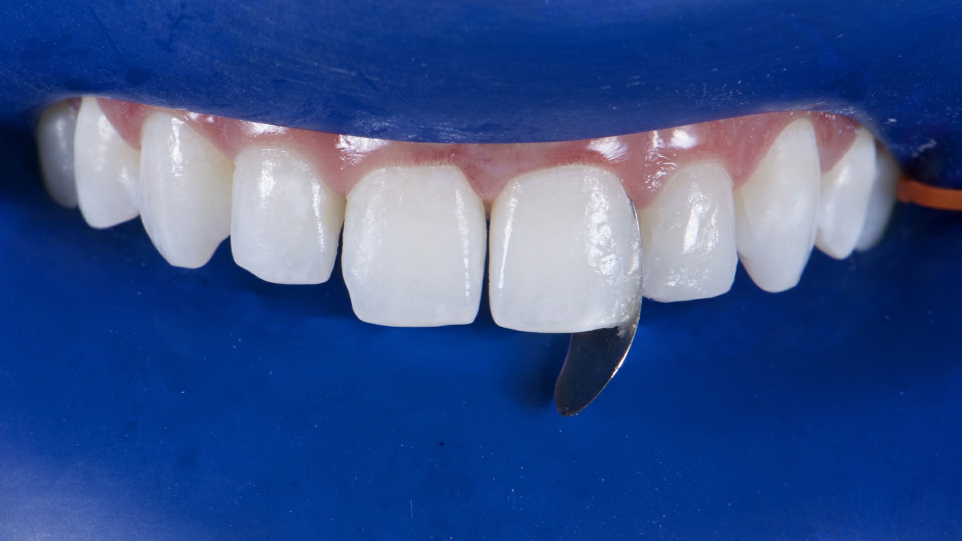 Fig.13: Reanatomização da face distal do dente 21 com matriz biconvexa.