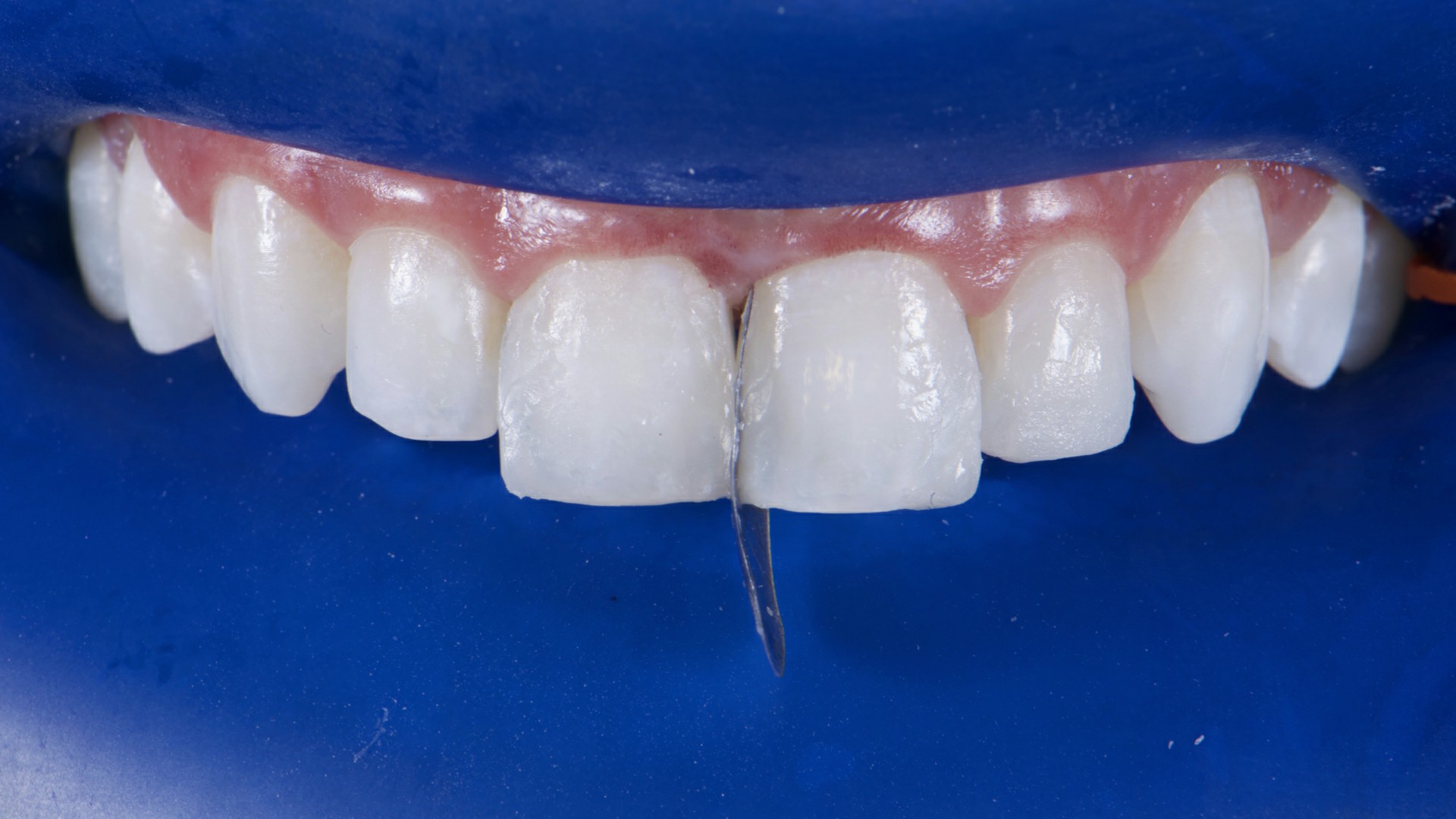 Fig.14: Reanatomização da face mesial do dente 21 com matriz biconvexa.