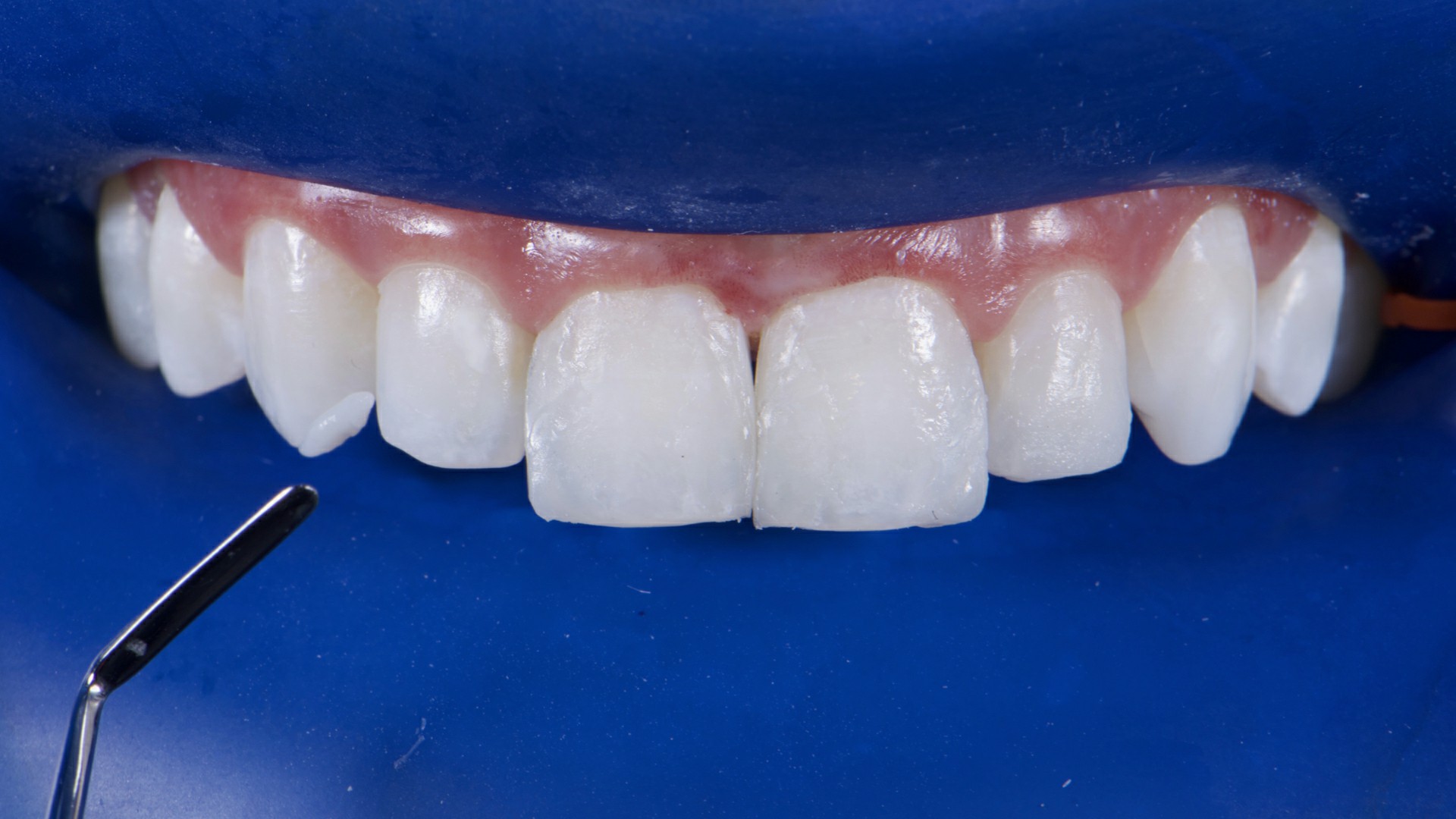 Fig.15: Contornos dentales de los dientes anteriores ya restablecidos.