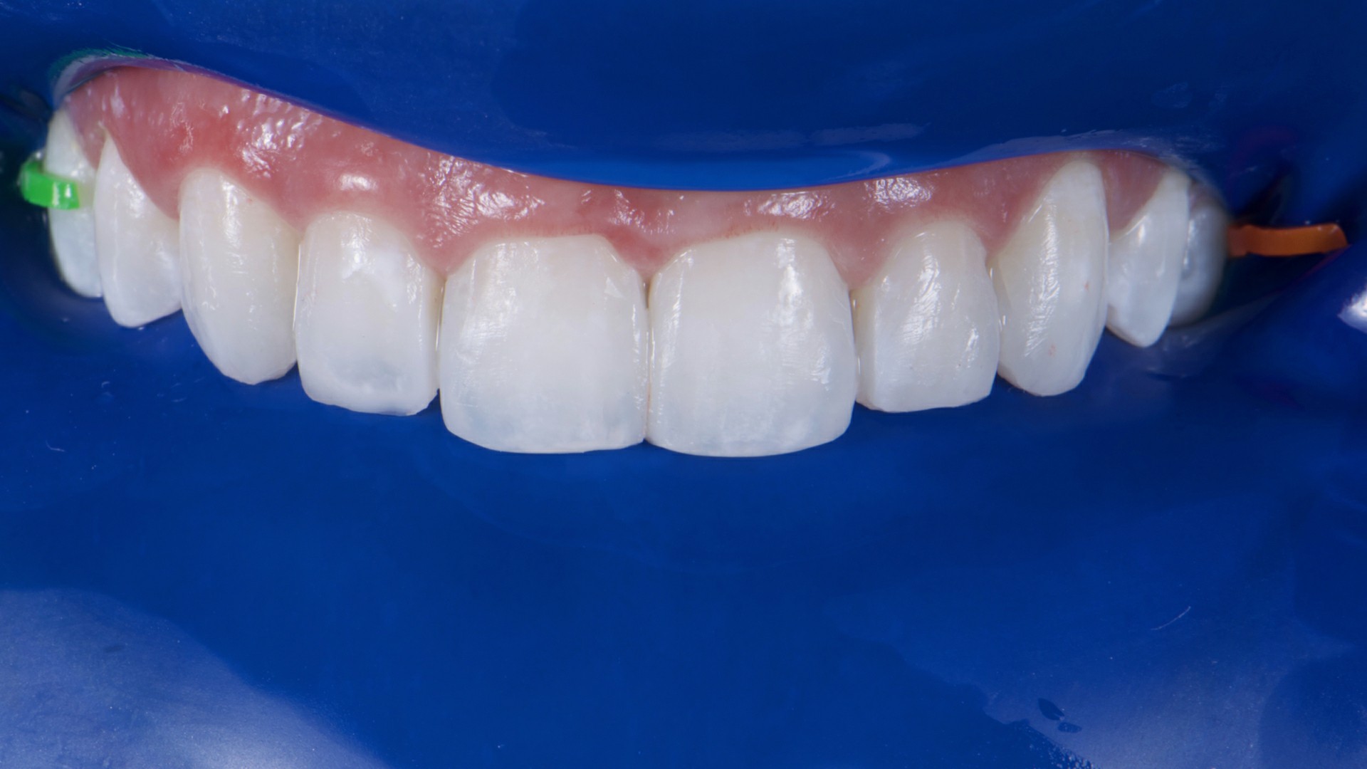 Fig.17: Vista aproximada dos contornos dentais restabelecidos.