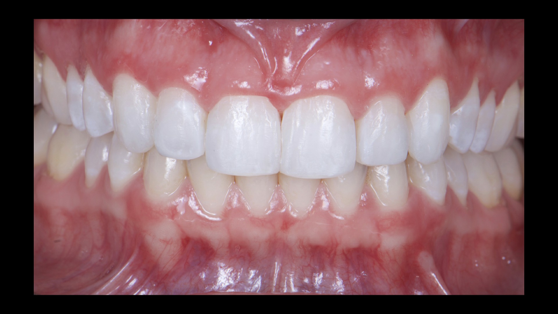Fig.18: Foto intraoral en máxima intercuspidación habitual con los contornos de los dientes anteriores restablecidos presentando la mimetización de los composites con las estructuras dentales.
