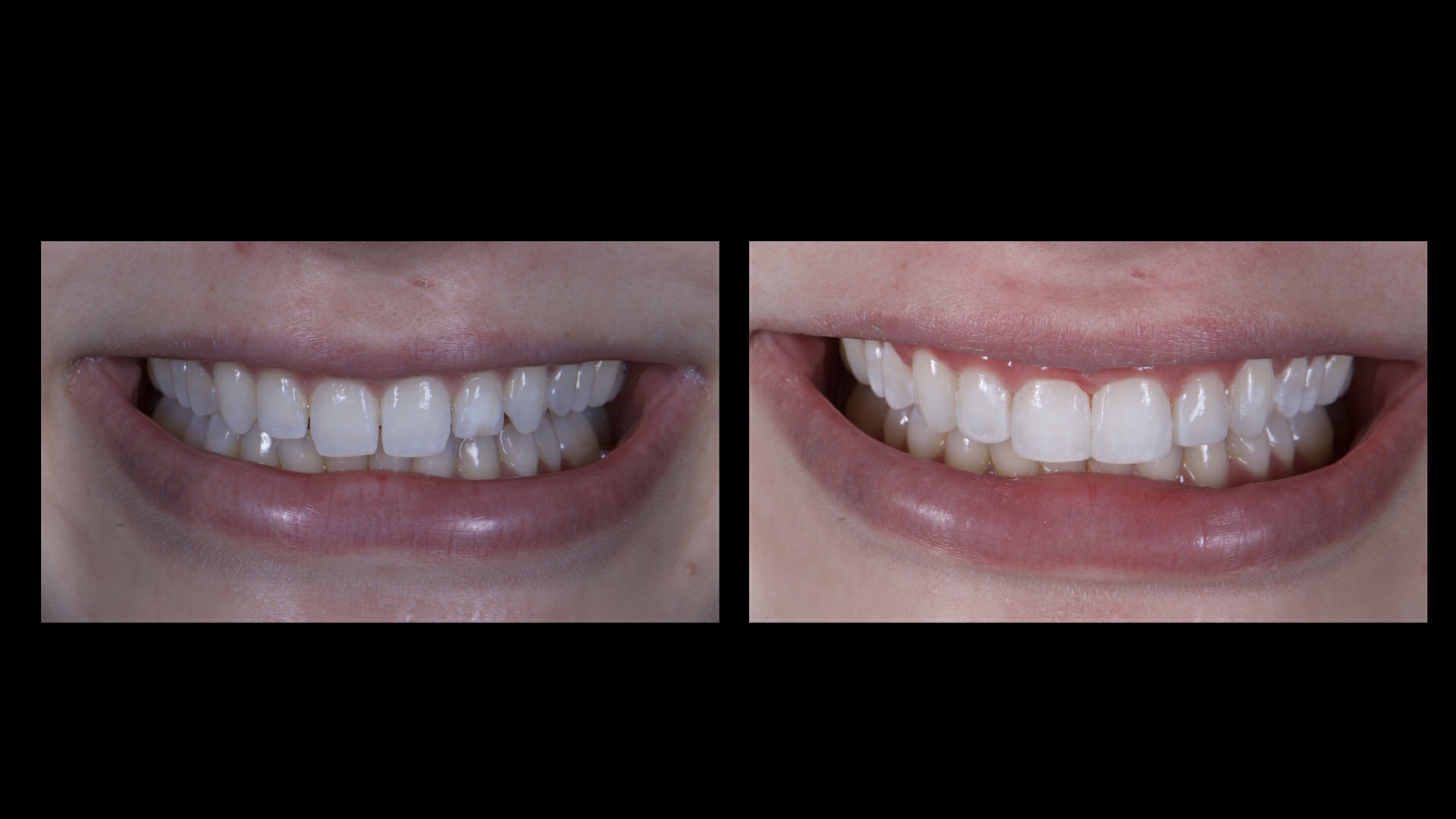 Fig. 19: Initial aspect (E) and final smile (D).