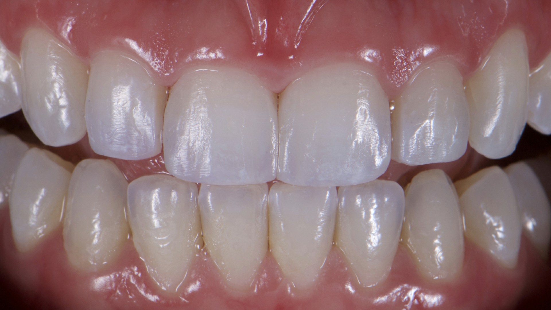 Fig.20: Vista aproximada dos contornos dentais restabelecidos.