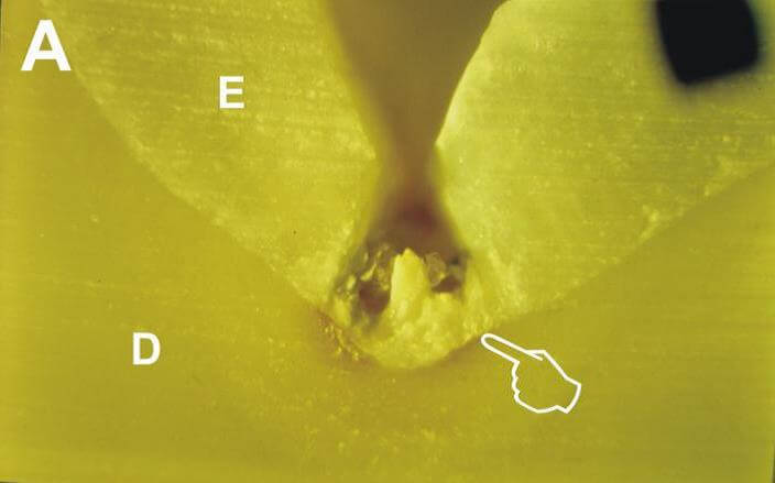 Imagem de Microscópio óptico comum Axiophot (zeiss) 20X, exemplificando lesões cariosas em fóssulas e fissuras. (E) esmalte, (D) dentina. (Sundfield em 2001 – Tese Livre Docência)