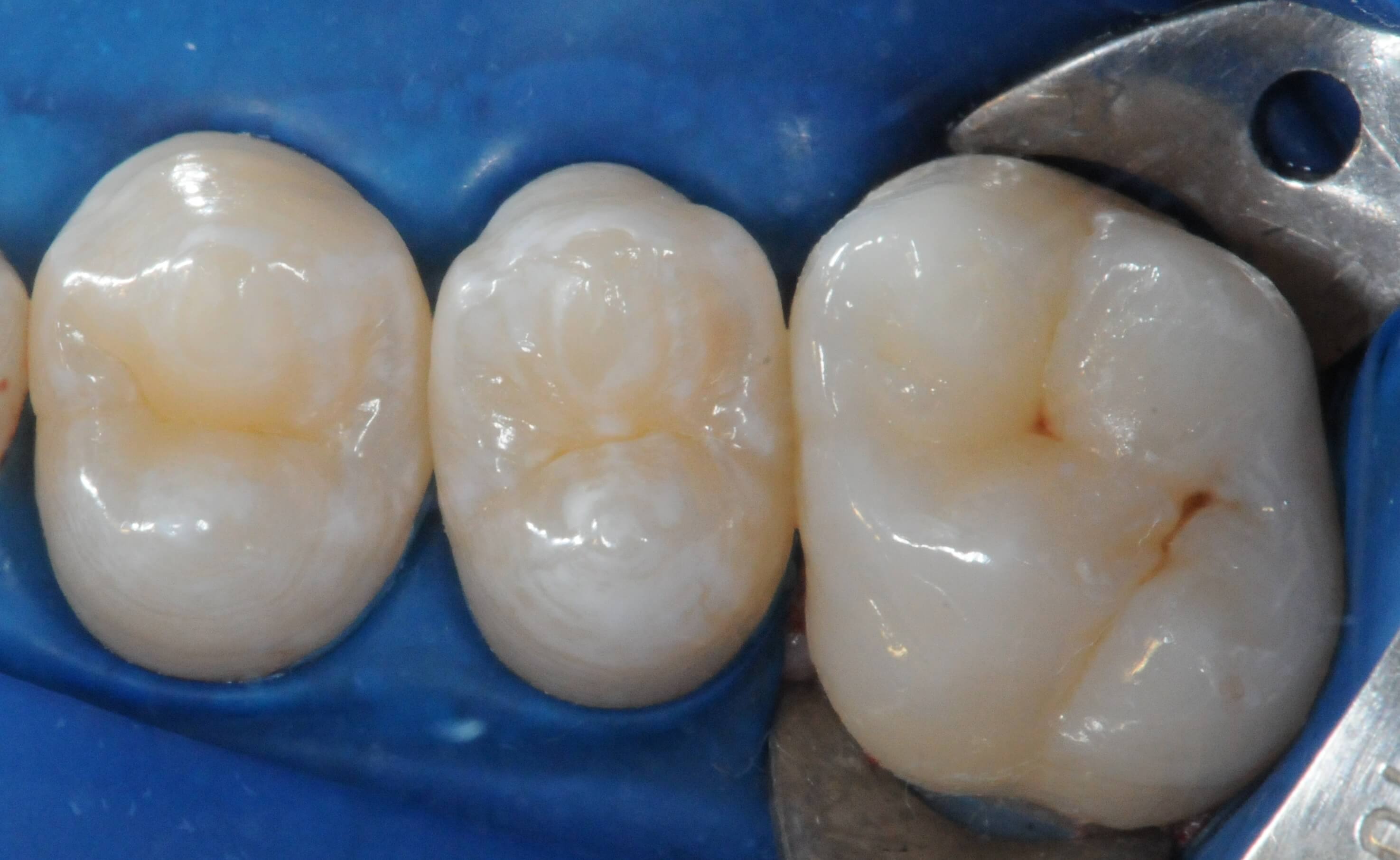 Isolamento absoluto dos dentes a serem selados com o selante Prevent (FGM).