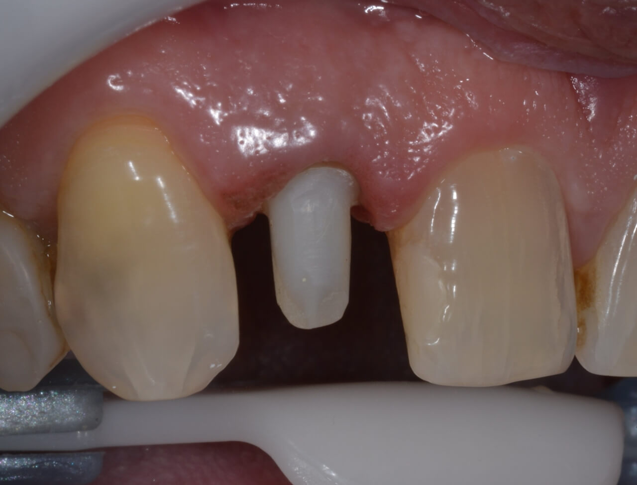 18. Após remoção do isolamento absoluto, o dente foi preparado e moldado com silicone de adição para confecção da coroa cerâmica.