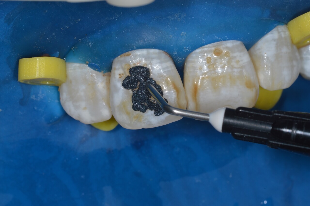 Aplicação do Whitenesse RM sobre a superfície do dente 11.