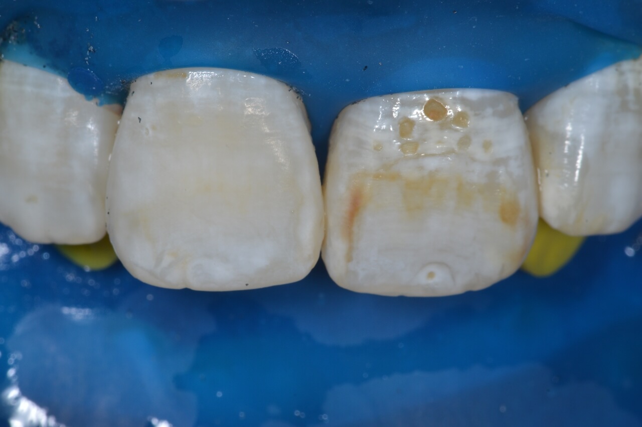 Efeito conseguido com as primeiras aplicações sobre o dente 11.
