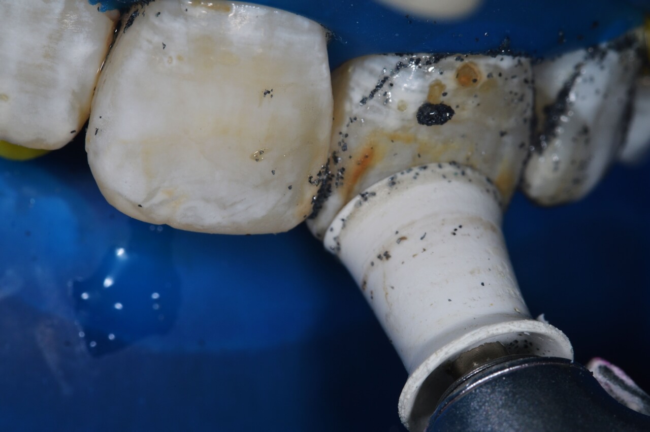 Taça de borracha em baixa rotação aplicando o Whiteness RM contra a superfície vestibular do dente 21.