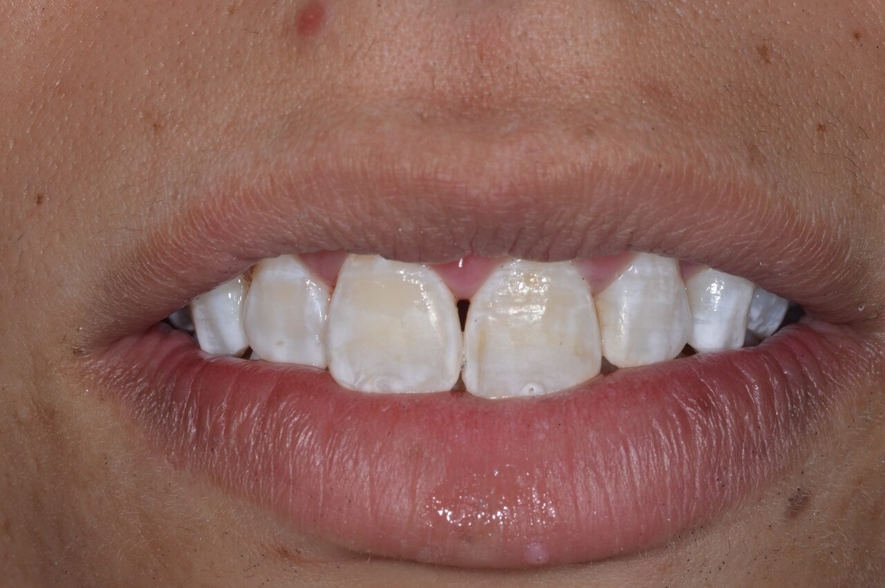 19. Foi retirado o isolamento absoluto para que a paciente tivesse idéia de como os dentes poderiam ficar pela ação da terapia.