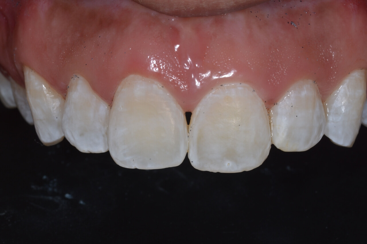 19a. Foi retirado o isolamento absoluto para que a paciente tivesse idéia de como os dentes poderiam ficar pela ação da terapia.