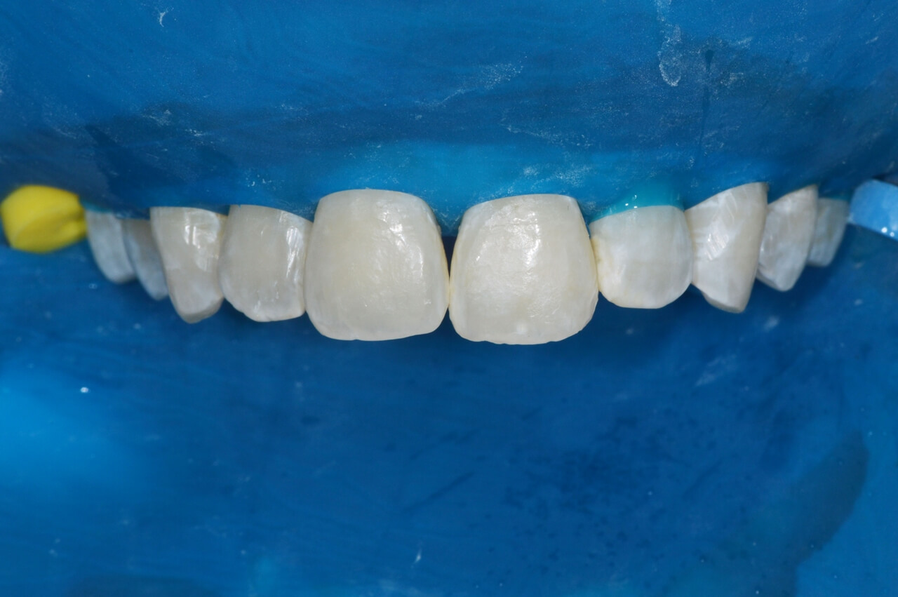 Isolamento absoluto expandido para a arcada superior de pré-molar a pré-molar e aspecto ao termino de 10 aplicações do produto.