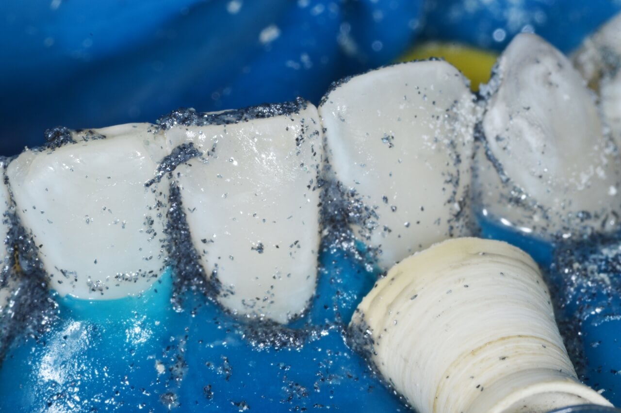 Aplicação do Whiteness RM sobre a superfície vestibular dos dentes inferiores.