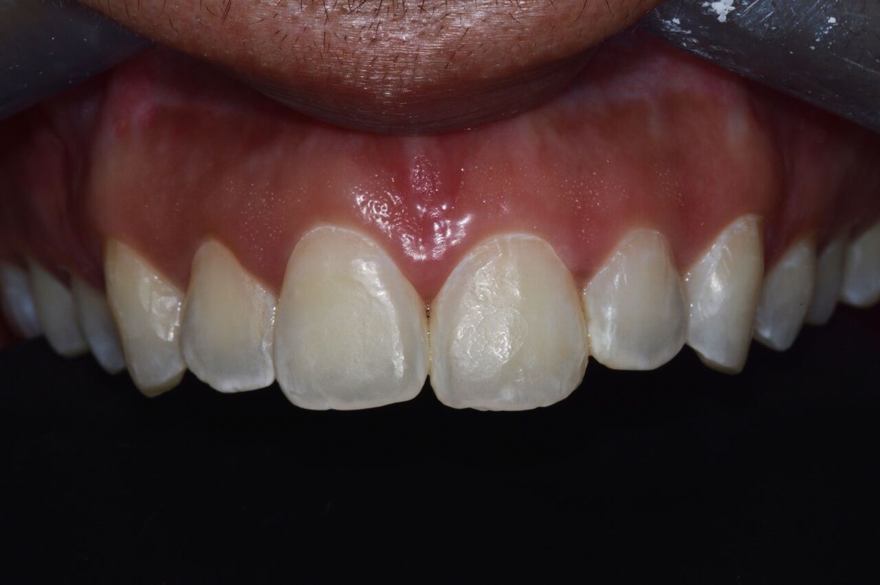 Dentes superiores sobre fundo preto para avaliação do efeito da microabrasão.