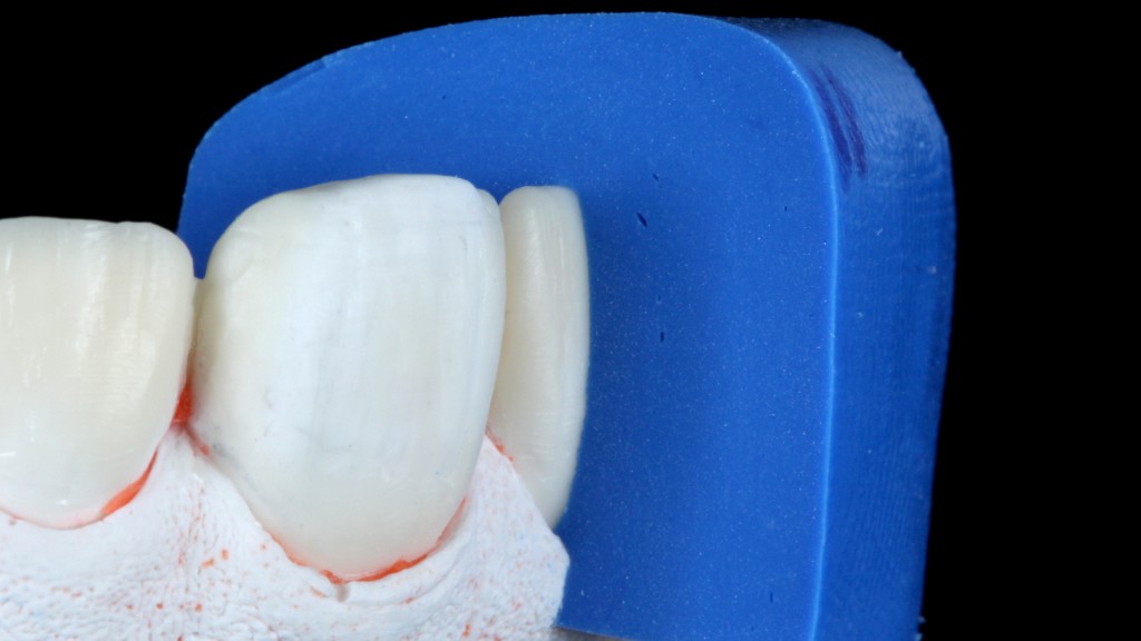 4a e 4b. Guia de preparo dental em silicone criada sobre o modelo encerado e adaptada nos dentes já preparados, evidenciando a quantidade de desgaste obtida. Neste caso optou-se pela técnica modified prepless (“sem preparo” modificada)1, onde se faz um preparo cervical de aproximadamente 0,2 mm na linha da gengiva com ponta diamantada cilíndrica de ponta arredondada (KG Sorensen) montada em contra-ângulo multiplicador com rotação em torno de 50.000 rpm, permitindo precisão e delicadeza. Nas proximais também foi realizado preparo 0,2 mm com uma ponta diamantada cônica longa. Os preparos foram realizados sobre o mock up em posição com o auxílio de “guias de silicone” que permitiram o desgaste preciso e conservador necessário para a cerâmica. Tais guias de preparo permitem a checagem da espessura desgastada nas diferentes regiões, evitando a remoção desnecessária de estrutura sadia.