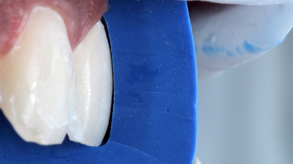 4a e 4b. Guia de preparo dental em silicone criada sobre o modelo encerado e adaptada nos dentes já preparados, evidenciando a quantidade de desgaste obtida. Neste caso optou-se pela técnica modified prepless (“sem preparo” modificada)1, onde se faz um preparo cervical de aproximadamente 0,2 mm na linha da gengiva com ponta diamantada cilíndrica de ponta arredondada (KG Sorensen) montada em contra-ângulo multiplicador com rotação em torno de 50.000 rpm, permitindo precisão e delicadeza. Nas proximais também foi realizado preparo 0,2 mm com uma ponta diamantada cônica longa. Os preparos foram realizados sobre o mock up em posição com o auxílio de “guias de silicone” que permitiram o desgaste preciso e conservador necessário para a cerâmica. Tais guias de preparo permitem a checagem da espessura desgastada nas diferentes regiões, evitando a remoção desnecessária de estrutura sadia.