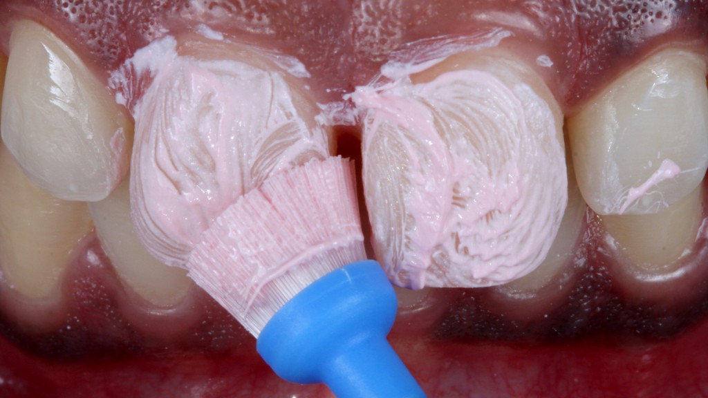 7. Profilaxia dental para promover substrato adequado para o procedimento adesivo.