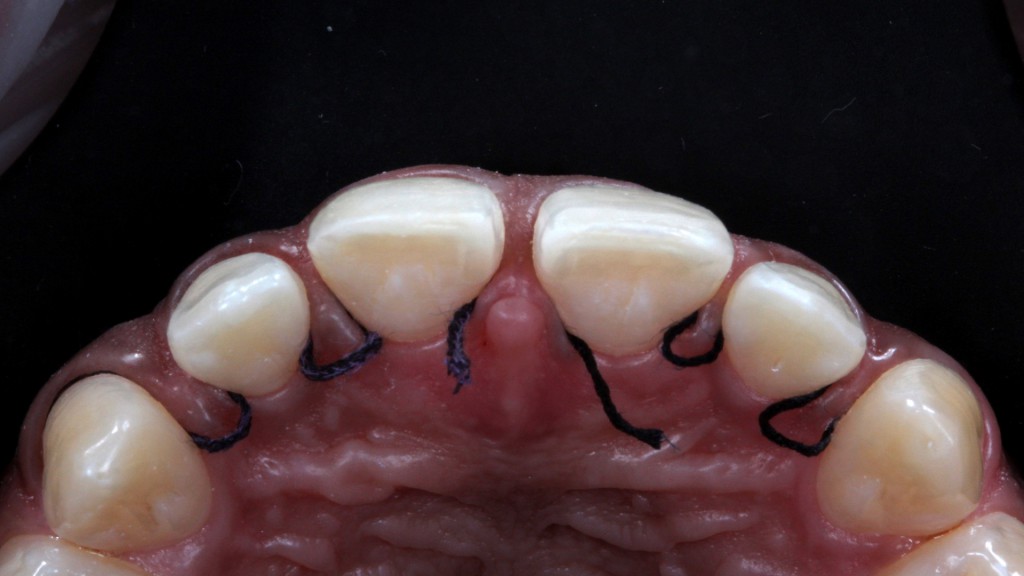 12a e 12b. Na etapa da cimentação, os dentes recebem fio afastador contínuo para expor devidamente os términos cervicais, controlar a umidade proveniente do sulco gengival e facilitar a remoção de excessos de cimento dentro do sulco gengival após polimerização3.