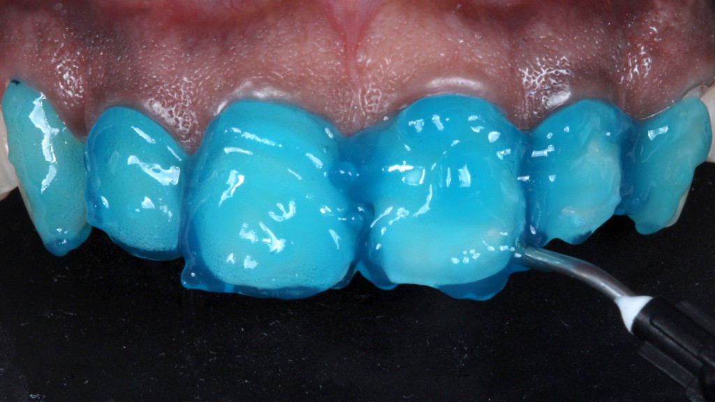 13a a 13c. Preparos dentais sendo condicionados com ácido fosfórico a 37% (Condac 37) durante 15 segundos. Após lavagem por 30 segundos e secagem, observa-se um aspecto opaco e fosco do esmalte.