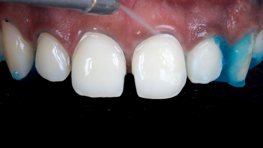 13a a 13c. Preparos dentais sendo condicionados com ácido fosfórico a 37% (Condac 37) durante 15 segundos. Após lavagem por 30 segundos e secagem, observa-se um aspecto opaco e fosco do esmalte.