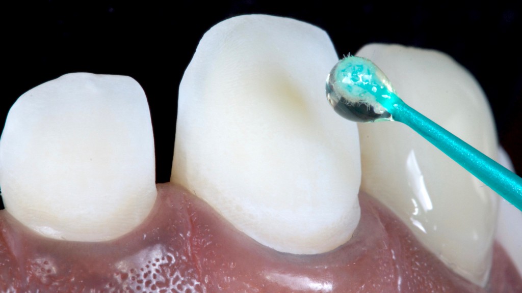 14a e 14b. Aplicação do adesivo dental (Ambar APS), de aspecto praticamente incolor que não interfere na cor final do trabalho.