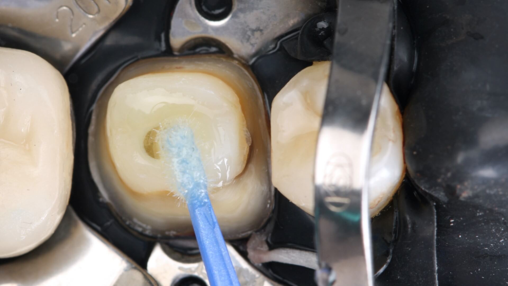 Fig. 11 – Aplicação do Sistema Adesivo sobre o remanescente dentário