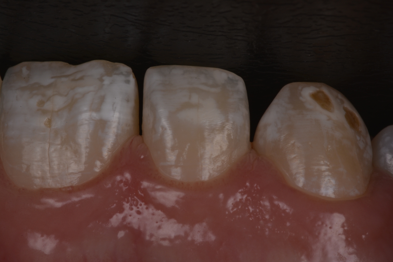 Aspecto do dente 12 antes e e após a transiluminação. Ao centro é perceptível uma hipoplasia mais profunda.