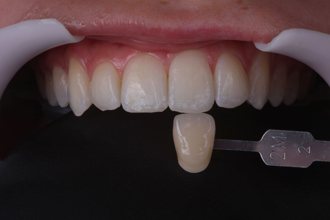 Registro da cor dos dentes