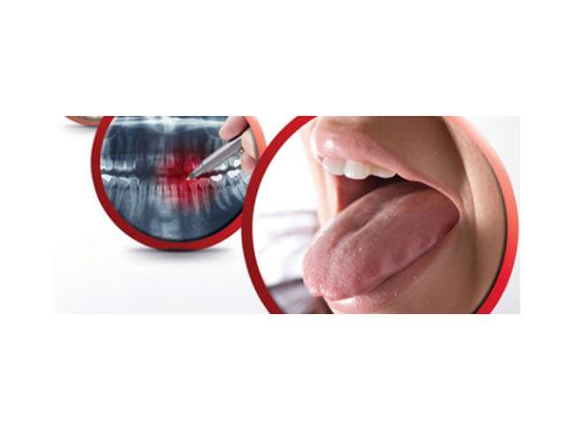 cpterra32oquesaoaftaselesoesbucais1 2 - Aftas e lesões bucais precisam de tratamento aftas e lesões bucais