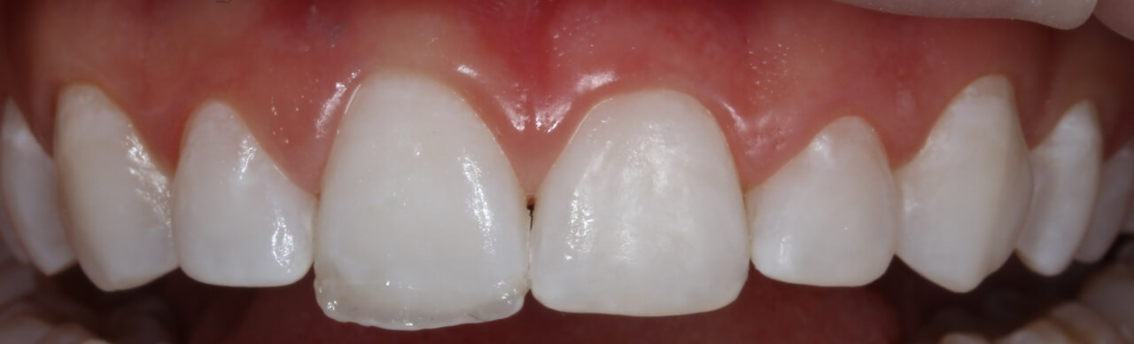 Fig. 2: Foto inicial intra-oral