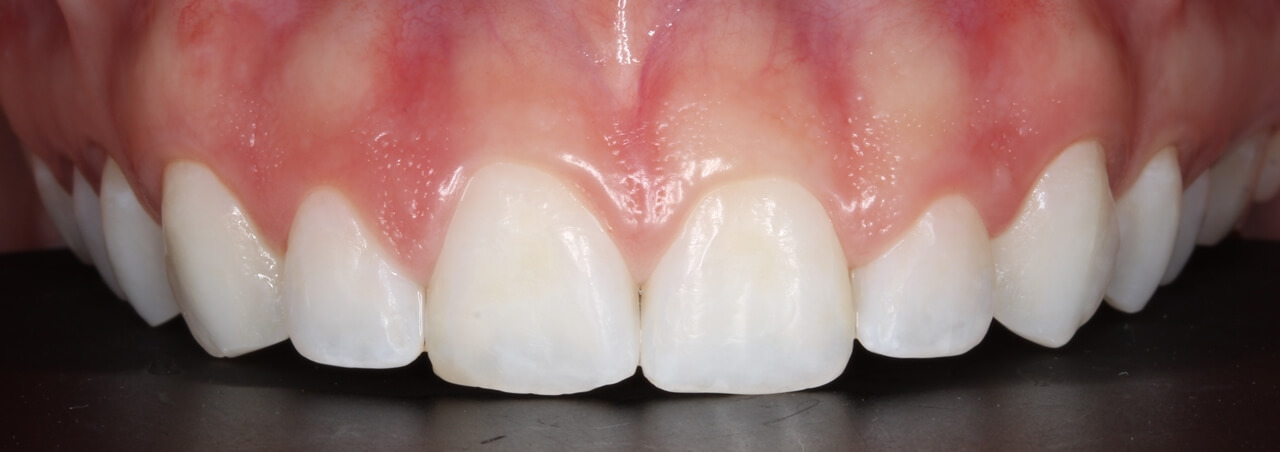 Fig. 2: Foto inicial intra-oral